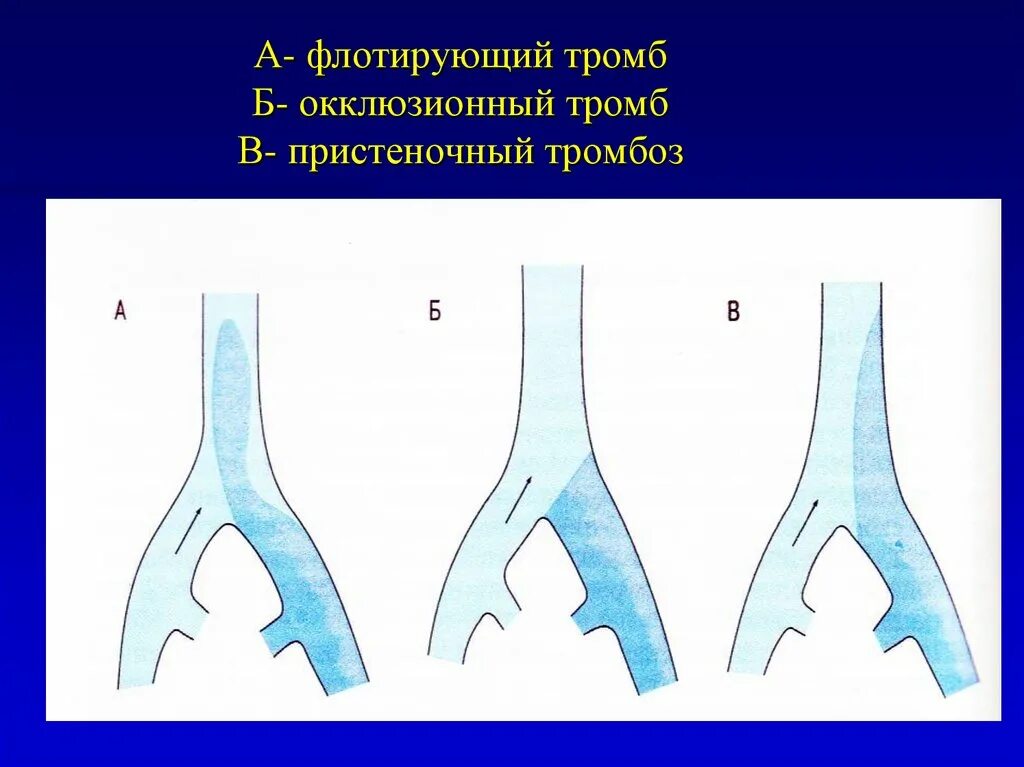 Флотирующий тромб аорты. Флотирующий тромб и пристеночный. Окклюзионный тромбоз