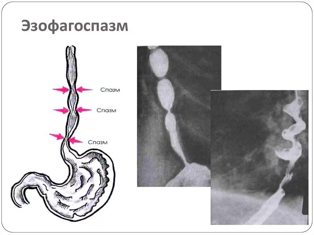 Сегментарный спазм пищевода рентген. Непроходимость пищевода рентген. Симптомы диффузного эзофагоспазма. Эзофагоспазм патогенез.
