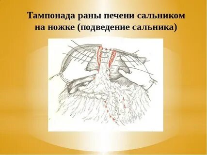 Тампонада раны