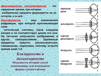 Гиперметропия слабой степени мкб