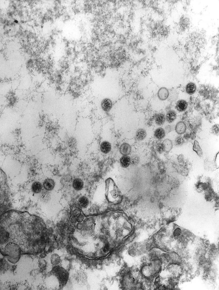 New insight into leading viral cause of congenital birth defects - News - Cardif