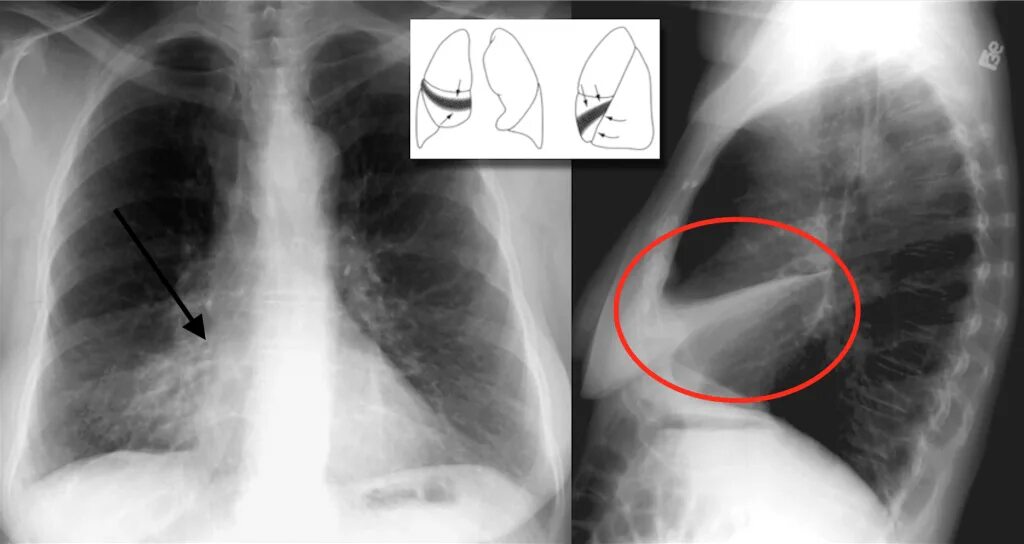 Доли легкого на рентгенограмме. Ателектаз средней доли правого лёгкого рентген. Ателектаз средней доли легкого. Ателектаз доли легкого на рентгенограмме. Фиброателектаз рентген.