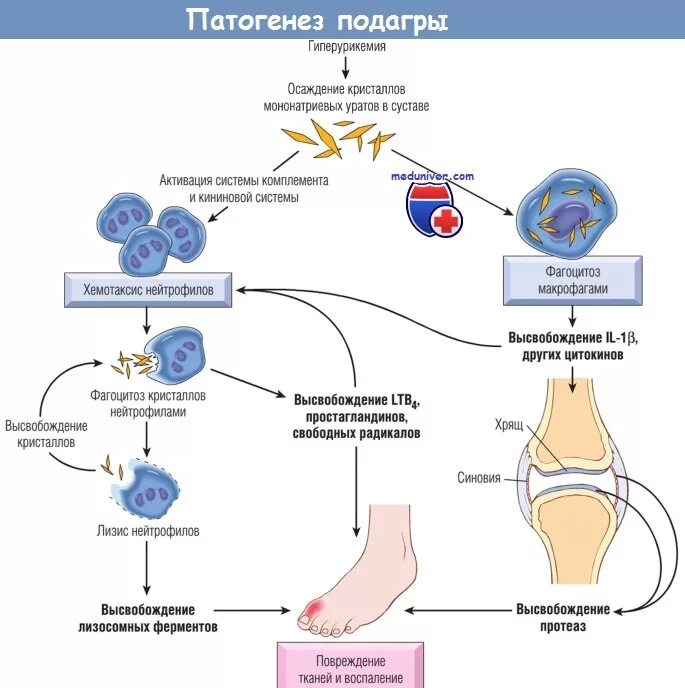 Подагра схема. Механизмы развития подагры схема. механизм развития подагры патофизиология. патогенез подагры патофизиология. патогенез подагры биохимия.