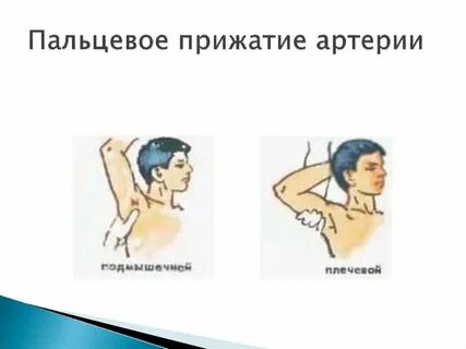Пальцевое прижатие артерии осуществляется ответ