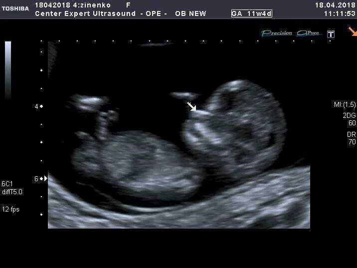 Важная дата - 12 недель и скрининг 1го триместра - 34 ответов форум Babyblog