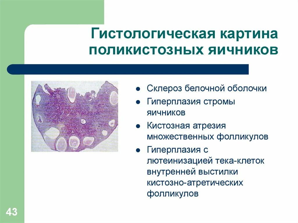 Доброкачественная гиперплазия предстательной железы (дгпж). Стромальная гиперплазия. Стромальная гиперплазия это. Микрожелезистая гиперплазия. Синдром поликистозных яичников гистология.