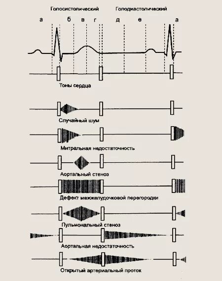Функциональные шумы ФКГ. Схема ФКГ 2 тона. Функциональные шумы сердца ФКГ. Шумы при пороках сердца таблица. Сердечные тоны шумы