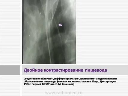 Подключичная артерия мкб