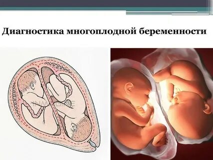 Рождение многоплодной беременности