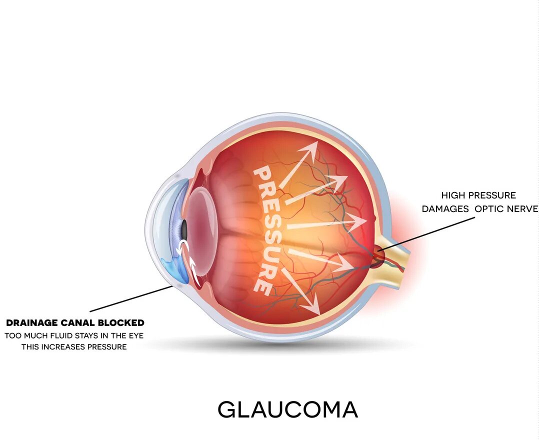 Глаукома это простыми словами. Глаукома этиология.