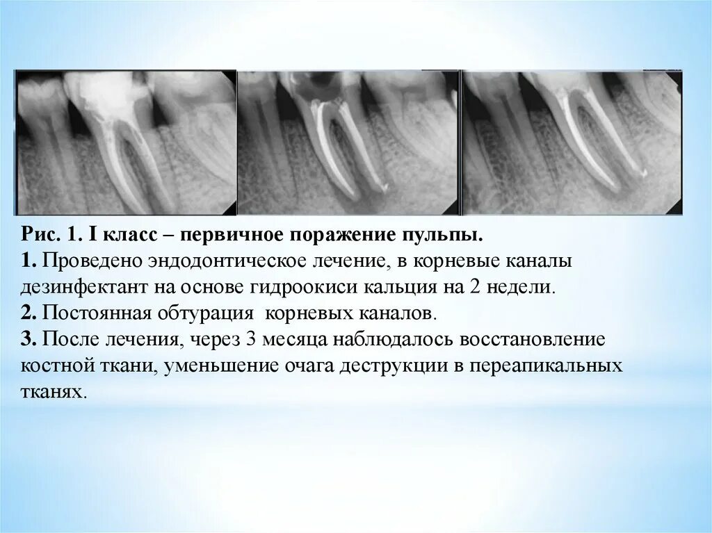 Кальций для корневых каналов. Временное пломбирование корневых