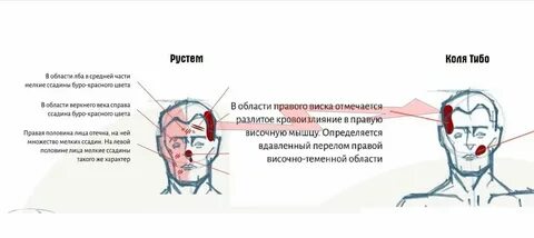 Сжимающие боли