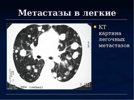 Операция на легких сколько времени