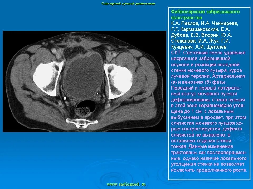 Утолщение мочевого пузыря у мужчин. Стенка мочевого пузыря утолщена кт. Утолщение стенки мочевого пузыря на кт. Стенки мочевого пузыря на кт. Утолщение стенки мочевого пузыря мрт.