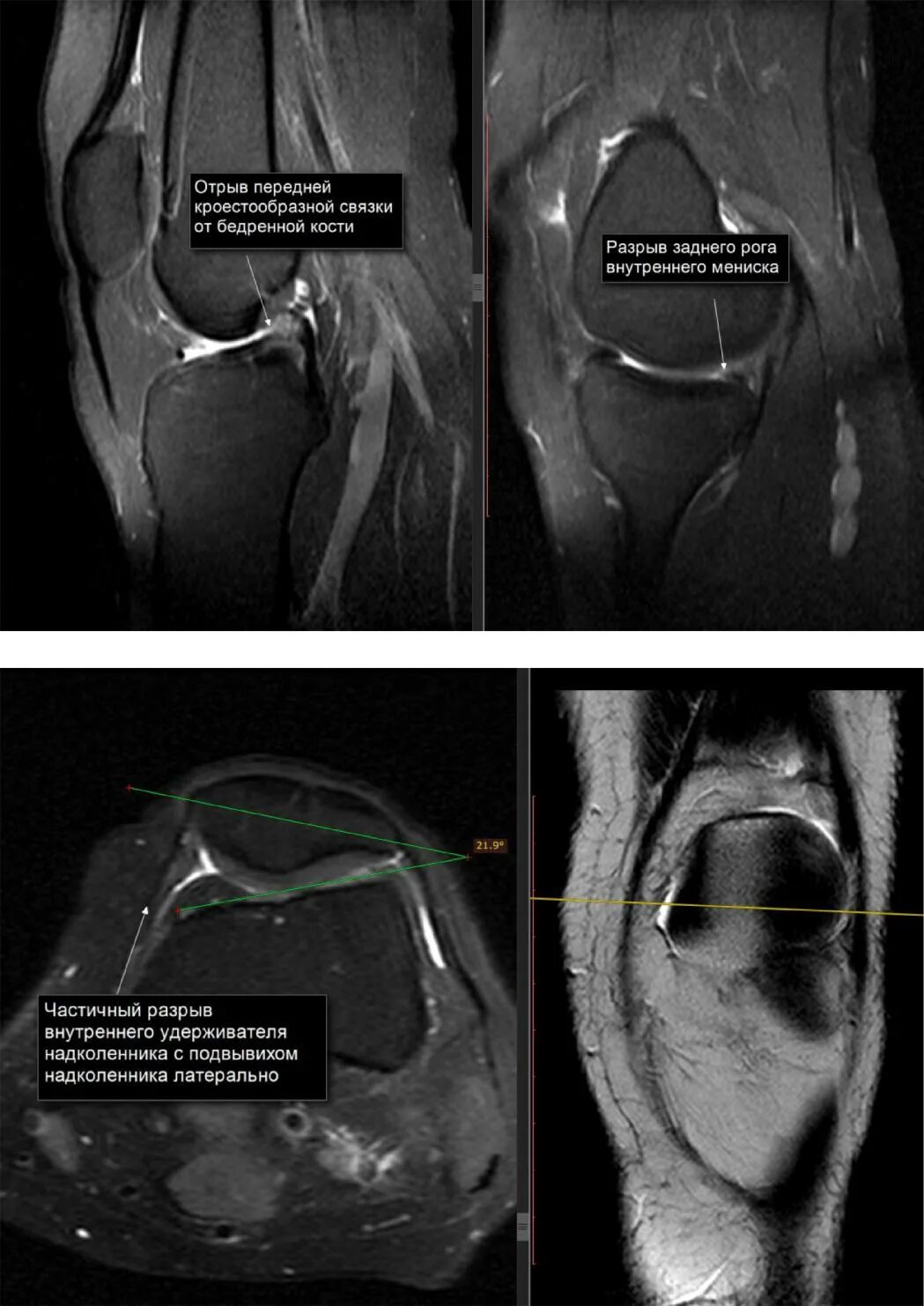 Снимок мрт коленного сустава с разрывом мениска. Повреждение переднего рога