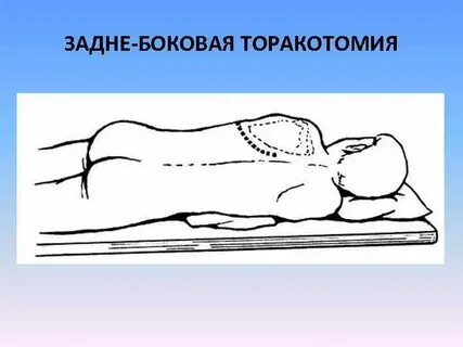 Торакотомия