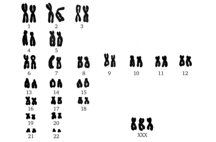 Полисомия по х-хромосоме кариотип. Синдром трисомии по х-хромосоме. Полисомия по y-хромосоме кариотип.