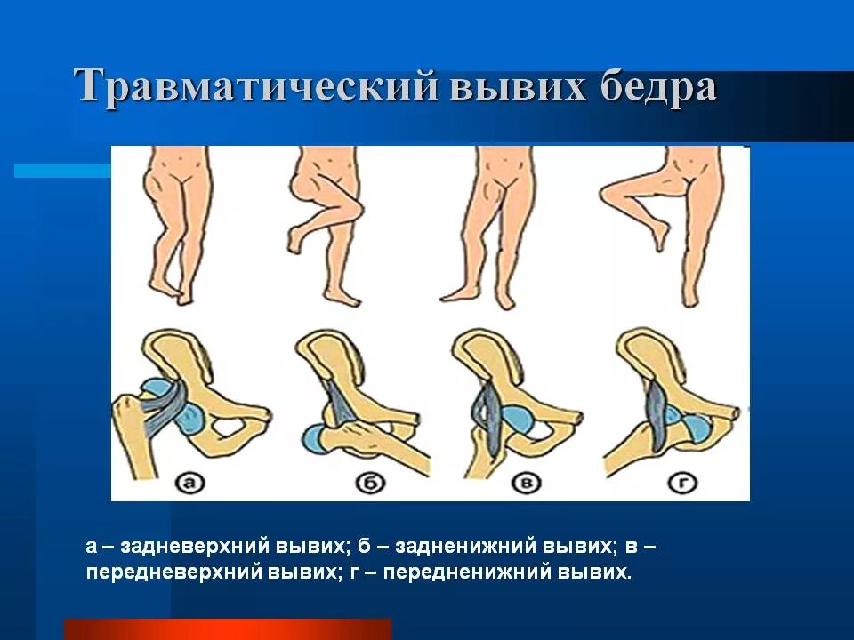 Травматический вывих бедра классификация. Вывих головки бедренной кости классификация. Травматический вывих бедра. Вывих тазобедренного сустава классификация.