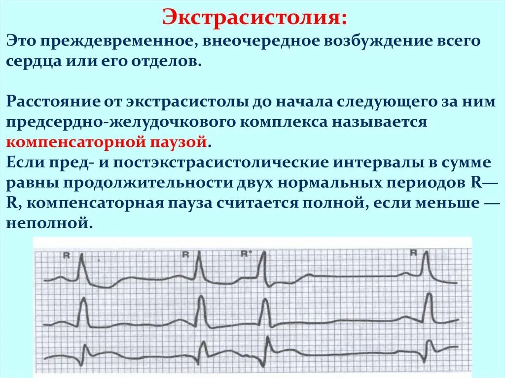 АВ экстрасистола. Экстрасистолы при нарушении проводимости. Экстрасистола физиология. Предсердно желудочковая экстрасистолия. Возникновение экстрасистол