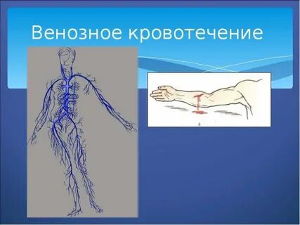 Венозные кровоизлияния