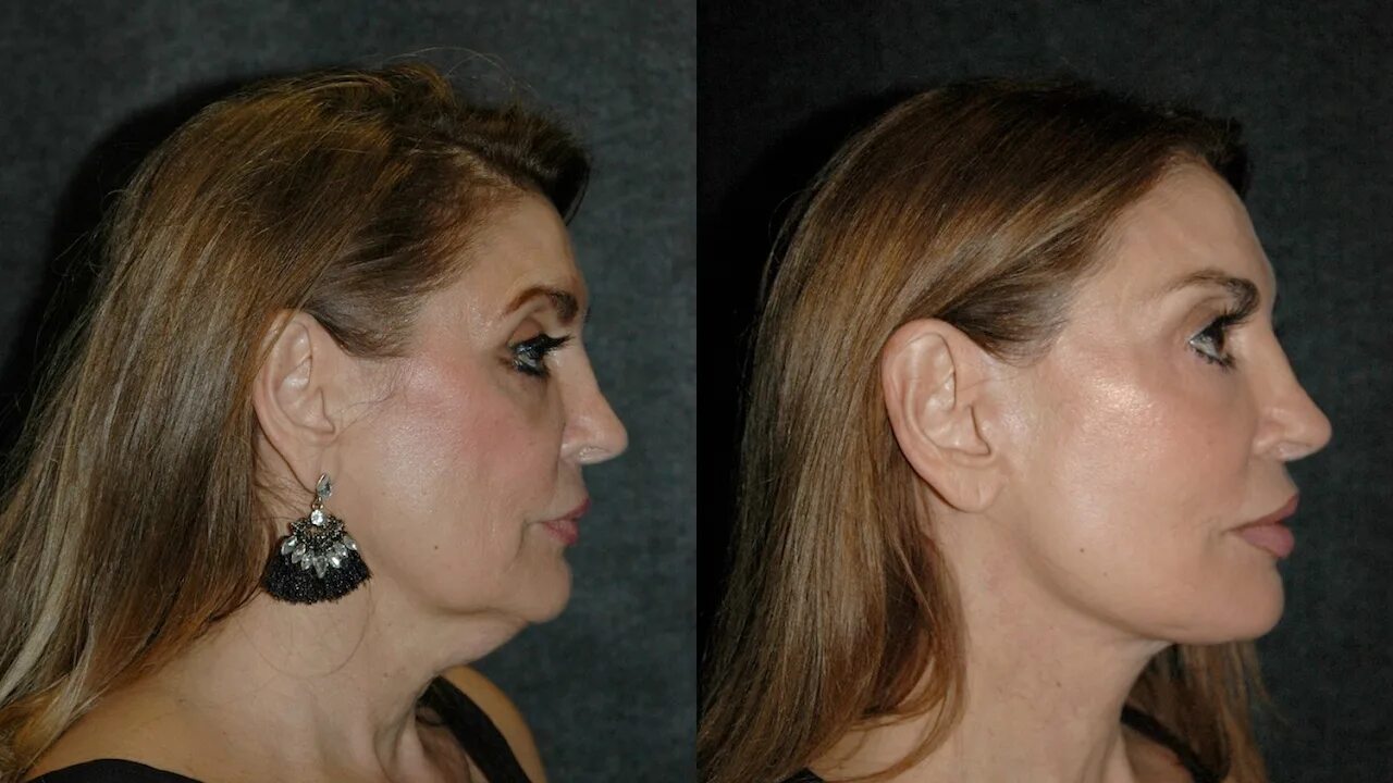 Deep lifting. Deep plane facelift edema.