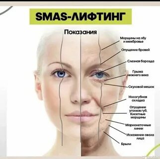 Смас лифтинг линии на лице