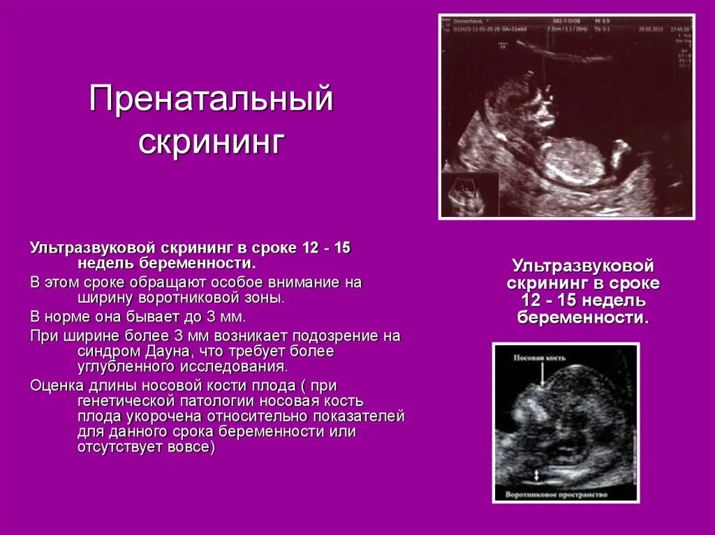 На каких сроках делается. Первый скрининг при беременности 12 недель. Первый скрининг при беременности 11-12 недель. Скрининг в 12 недель беременности показатели УЗИ. 12 Недель беременности триместр.