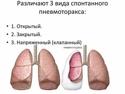 Закрытая рана грудной клетки