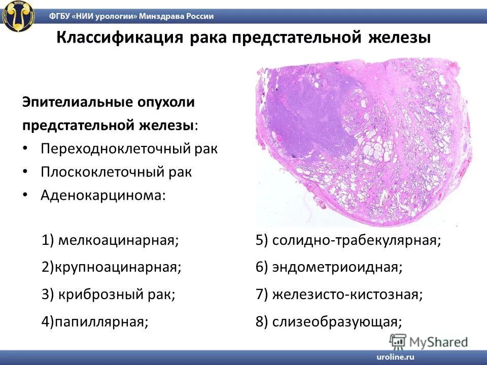 Стадии предстательной железы прогноз. Ацинарная аденокарцинома простаты гистология. Опухоли предстательной железы классификация. Классификация аденокарциномы простаты. Аденокарцинома предстательной железы классификация.