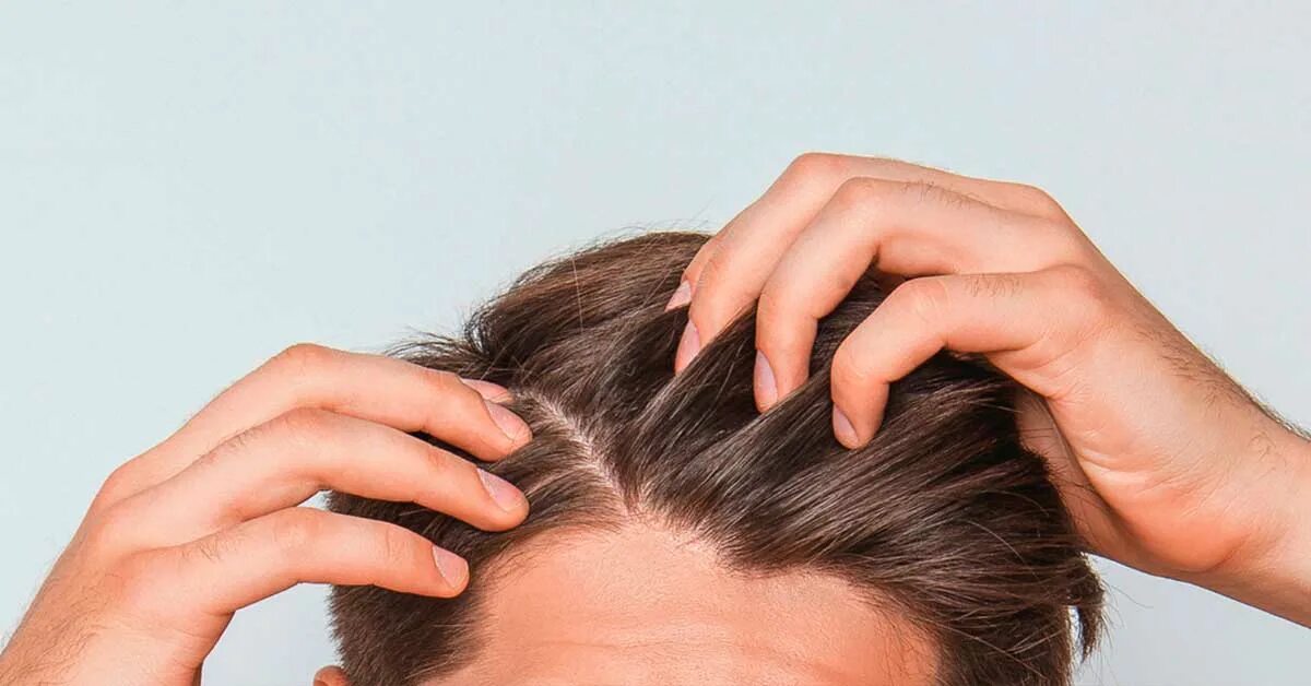 Чешуйки перхоти на голове. Здоровая кожа головы. Зуд кожи головы у ребенка. Зуд кожи головы у ребенка. Чесание затылка.