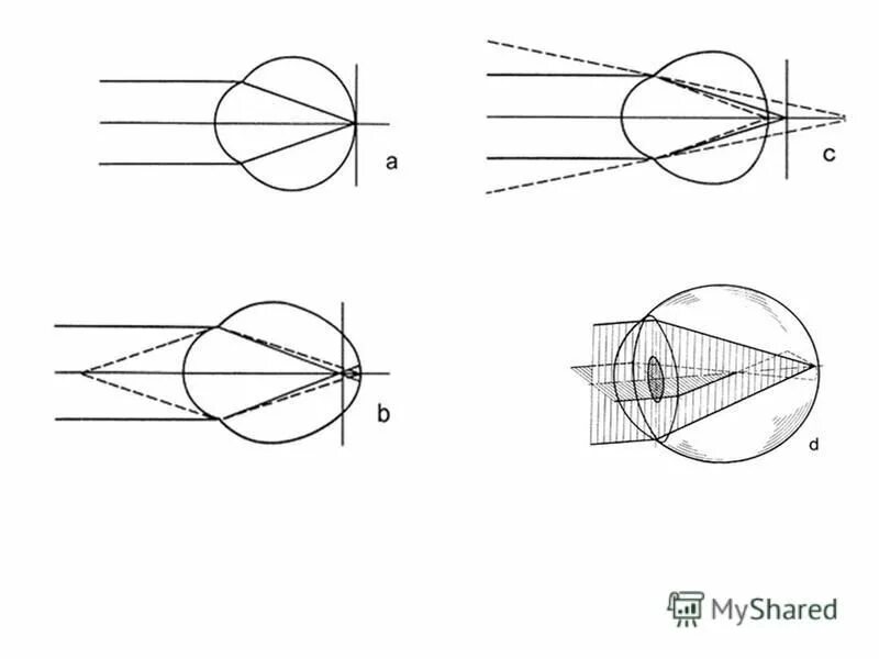 задней вершинной рефракции