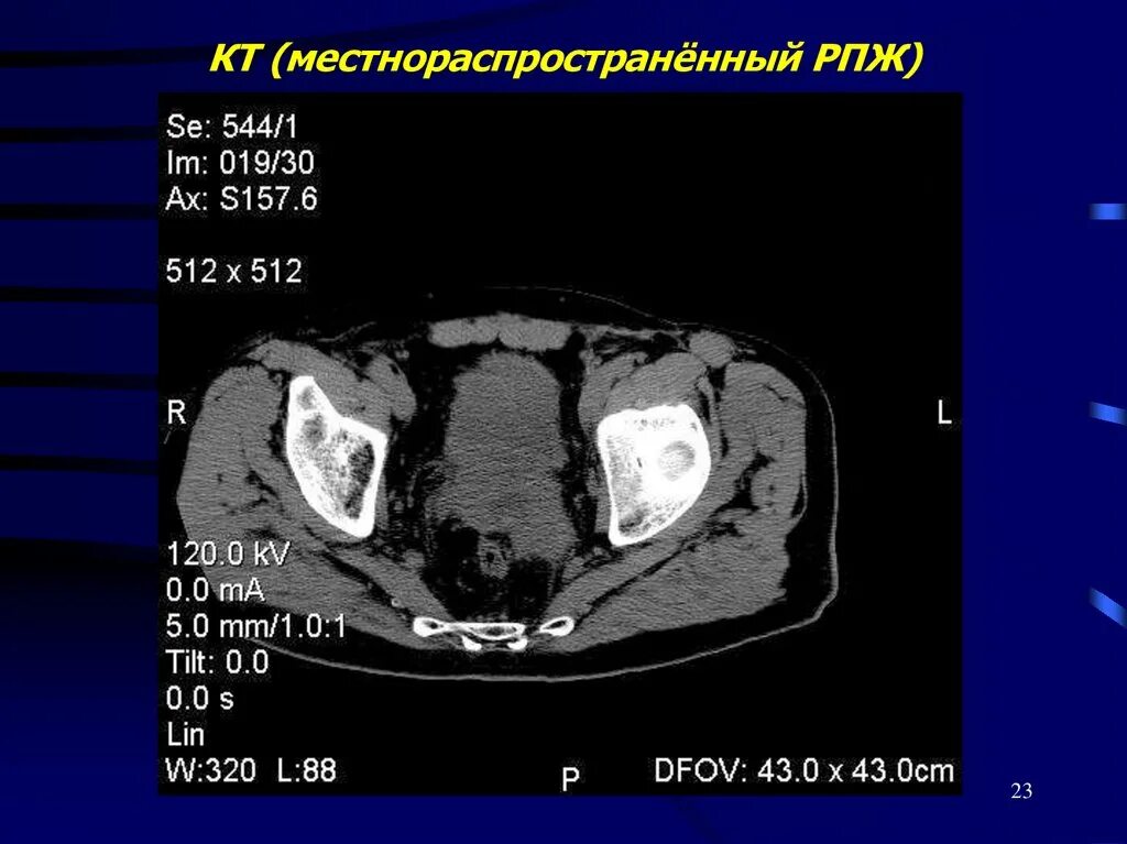 Простата рак симптомы лечение. Опухоли простаты презентация. Предстательная железа на кт. Предстательная железа изображение на кт. Объемное образование в предстательной железе кт.