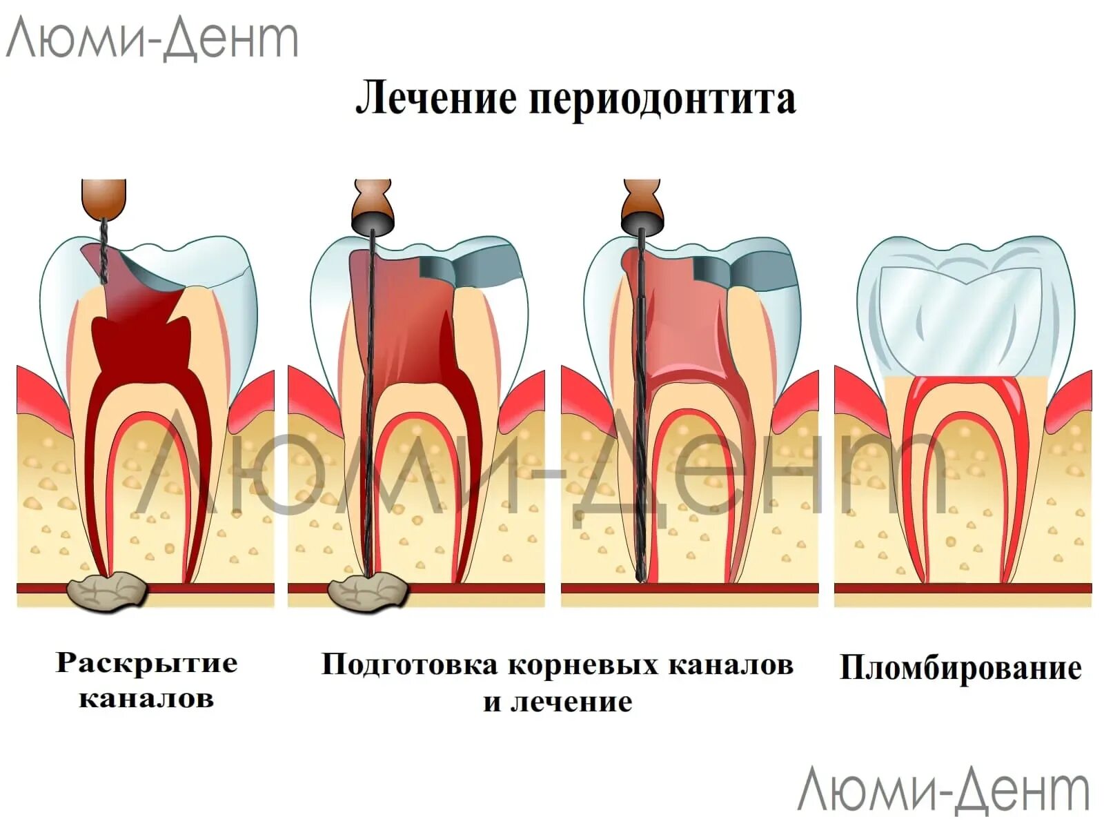 Сколько ходят с лекарством в зубе. Периодонтит 1 канальный.