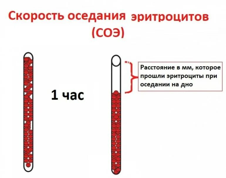 Соэ 3 мм. Методы исследования СОЭ. Оценка скорости оседания эритроцитов (СОЭ).. СОЭ метод Панченкова норма. Механизм увеличения СОЭ.