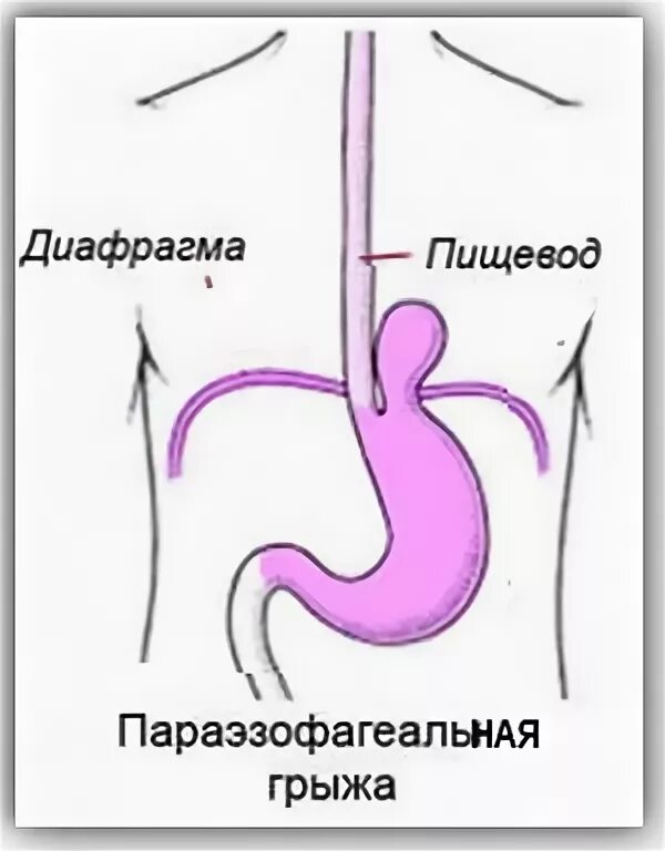 Грыжа пищевода что это симптомы и лечение