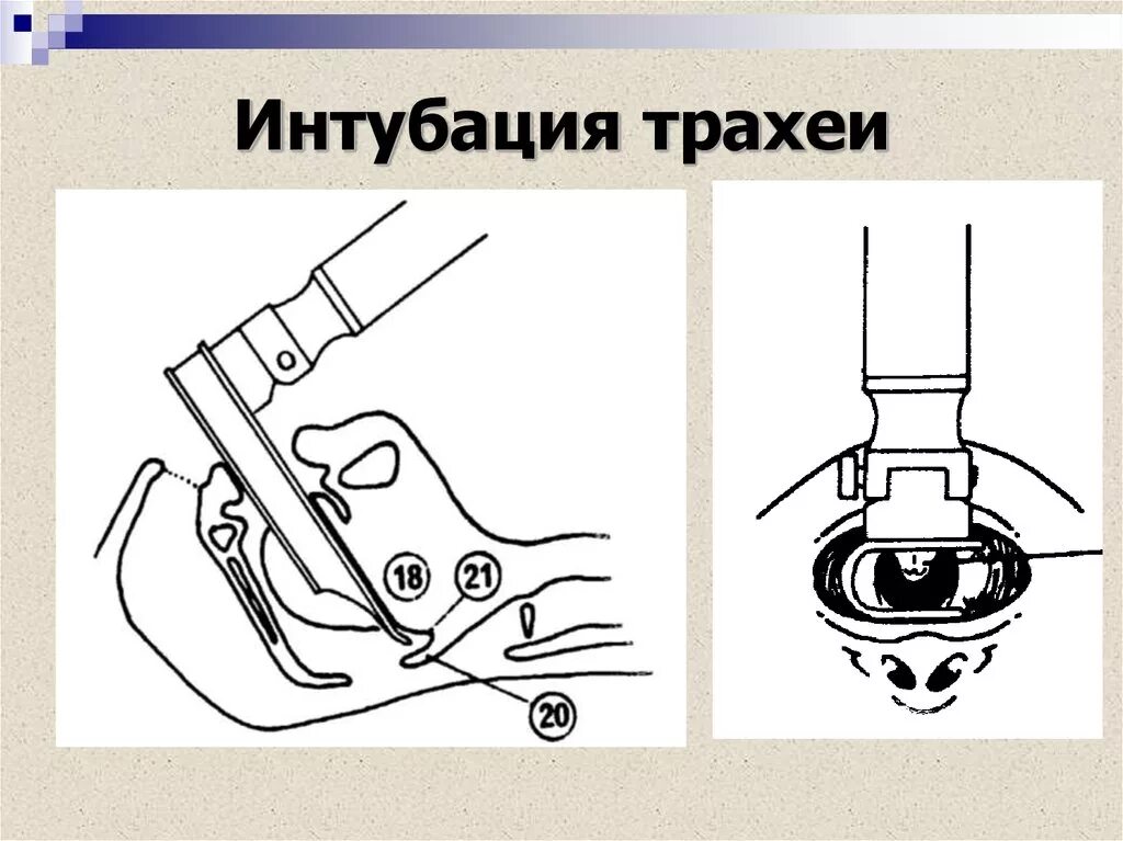 Для интубации трахеи необходим. Интубация трахеи алгоритм. техника интубации трахеи.