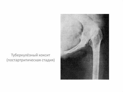 Коксит