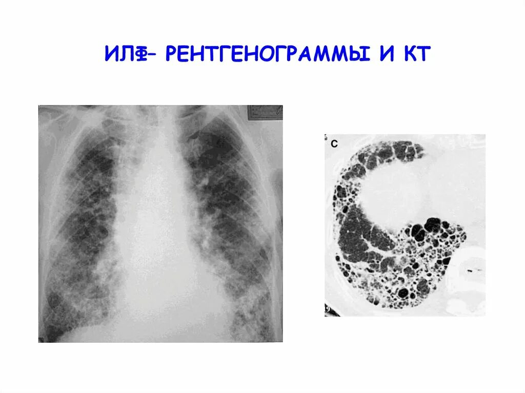 Эмфизема пневмосклероз. Очаговый пневмосклероз рентген. Легкие диффузные. Пневмосклероз и пневмофиброз. Легкие диффузные.