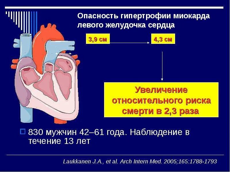 Желудочка сердца расширена. Гипертрофия левого желудочка сердца. Гипертрофия миокарда левого желудочка. Гипертрофия желудочка сердца. Миокарда левого желудочка сердца что это такое.