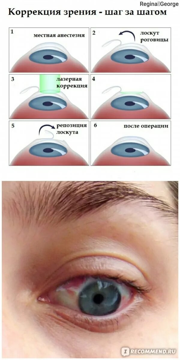 Кросслинкинг роговицы при кератоконусе и других болезнях: описание
