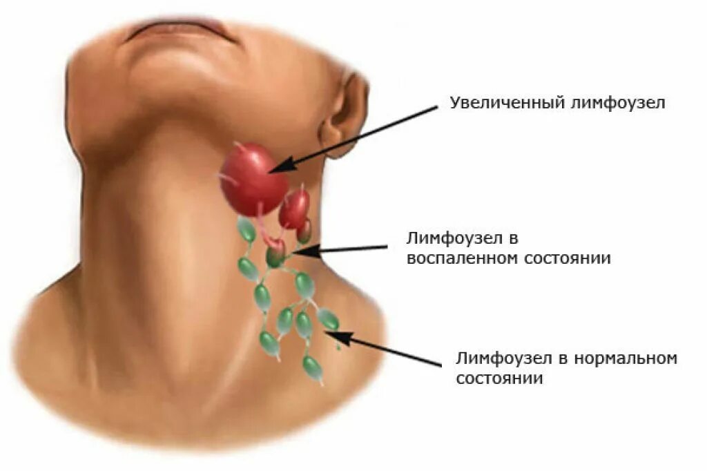 Причины болей лимфоузлов