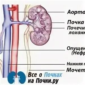 Опущение почки причины