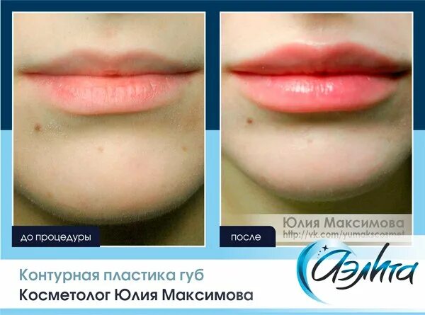 Увеличение губ рекомендации. Увеличение губ рекомендации. Памятка увеличение губ. Увеличение губ рекомендации. Рекомендации после коррекции губ.