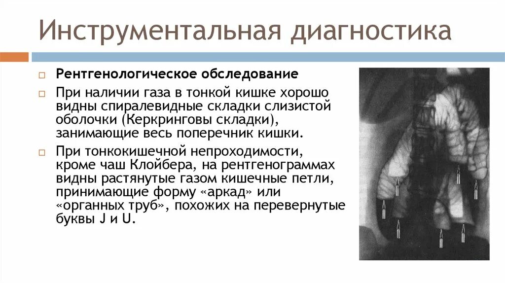Газ в тонкой кишке. Кишечная непроходимость рентген тонкокишечная. Кишечная непроходимость рентген тонкокишечная. Газ в тонкой кишке. Инвагинация толстого кишечника рентген.