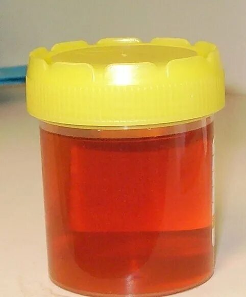 Темно коричневая моча. Красная моча у девушки. Моча при цистите у женщин. Цвет мочи с кровью. Нормальный цвет мочи.