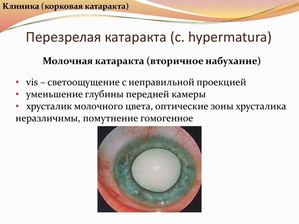 Кольцевидная катаракта Фоссиуса. Капсулярная врожденная катаракта. Возрастная катаракта осложнения. Начальная старческая катаракта