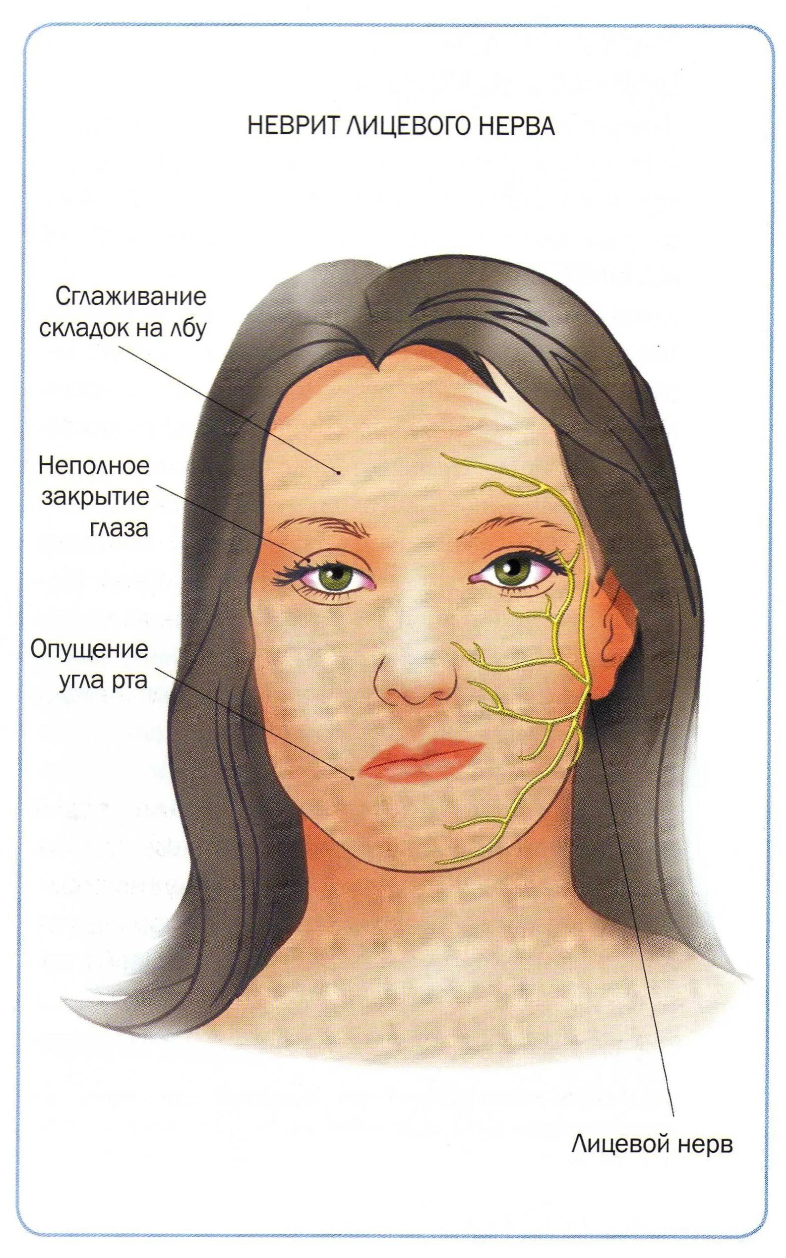Неврит тройничного нерва симптомы. Невралгия тройничного лицевого нерва. Воспаление лицевого нерва симптомы воспаление тройничного. Воспаление тройничного нерва на лице симптомы.