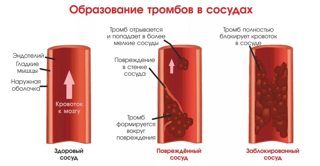 Сосуды после ковида. Тромб причины образования. Образование тромбов в артериях.