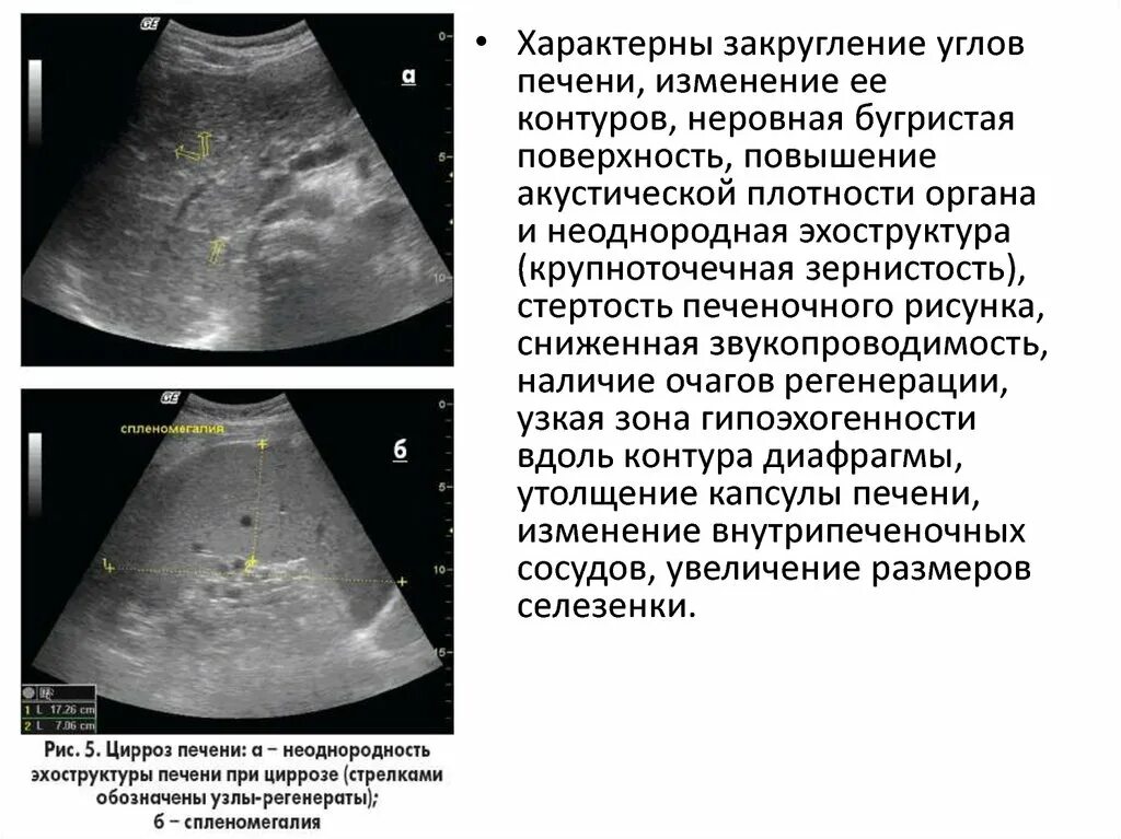 Края печени закруглены. Структура паренхимы печени неоднородная что это. Структура паренхимы печени на УЗИ. УЗИ печени эхоструктура. Эхоструктура поджелудочной железы.