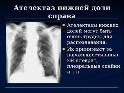 Дисковидный ателектаз легкого